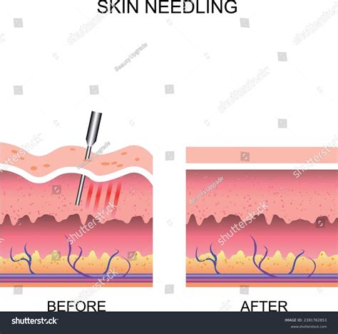 Skin Needling Before After Microneedling Procedure Stock Vector (Royalty Free) 2391762853 ...