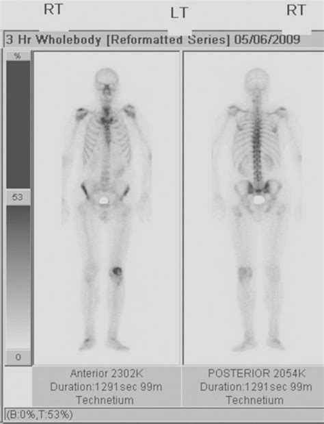 Bone Scan Testing 的图像结果