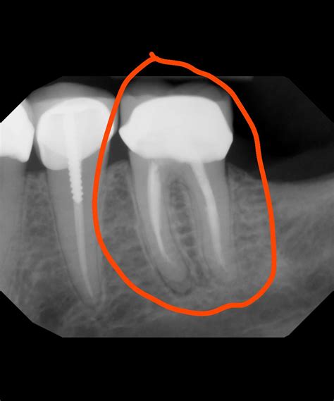 Periapical Abscess After Root Canal – GMLYP