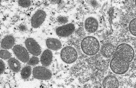 日媒：猴痘病毒存在人传人可能，暂无治疗方法_新民社会_新民网