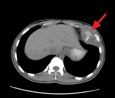 Ewing's sarcoma, causes, signs, symptoms, diagnosis, treatment & prognosis