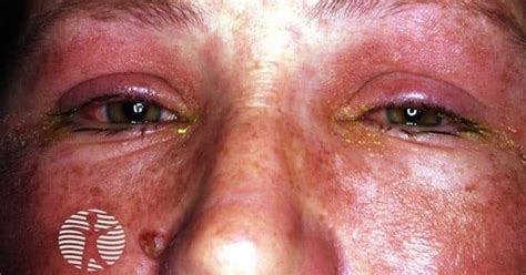 Rash Pictures SJS 的图像结果