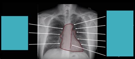 Image result for Chest X-Ray Tutorial