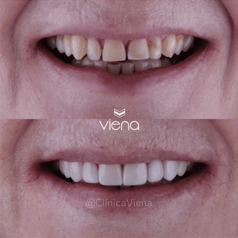 What They Dont Tell You About Veneers: Risks and Regrets