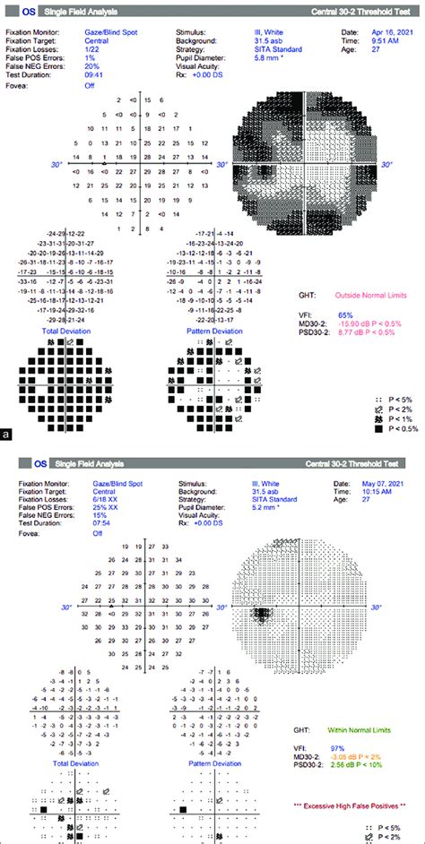 Image result for Visual Field Screen