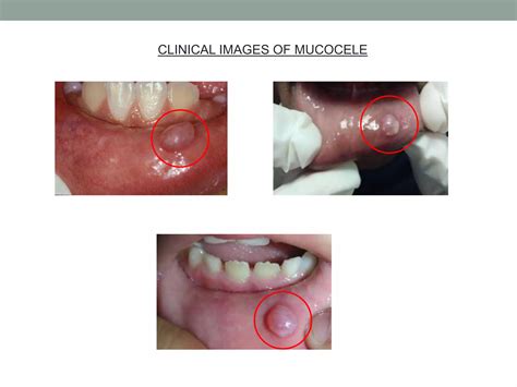 Mucocele | PPTX