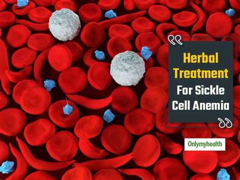 Herbal Treatment For Sickle Cell Anemia: Sailin-HbS Helpful In Anemia ...
