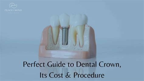 Dental Crown Procedure