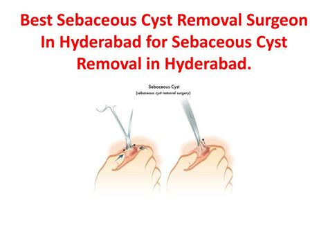 Image result for Sebaceous Cyst Removal Procedure