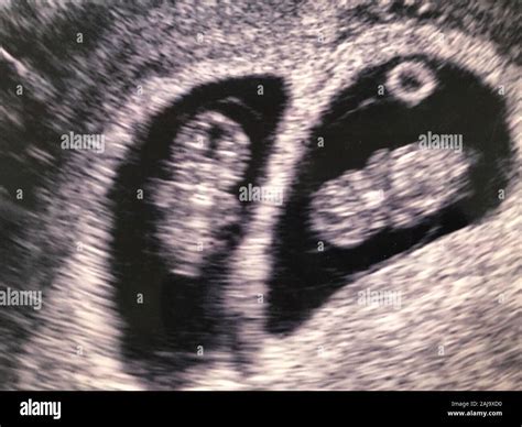 9 Week Ultrasound Identical Twins