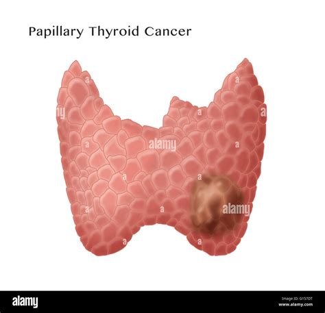 Papillary Thyroid Cancer Symptoms