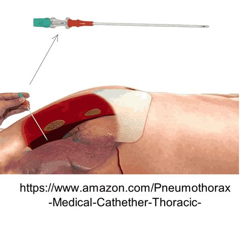 Image result for Needle Decompression Interior View