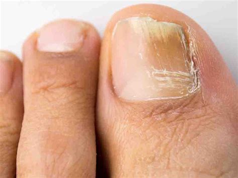 交了6年的智商税，终于知道如何根治灰指甲了，真菌感染、脚气、手足癣通通搞定 - 知乎
