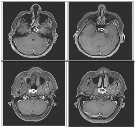 The diagnostic dilemma of Masticator space tumor - IP J Surg Allied Sci