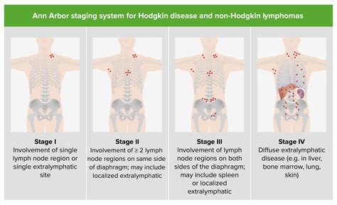 Non-Hodgkin Lymphomas | Concise Medical Knowledge