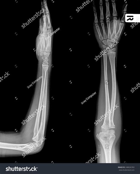 X Ray Arm