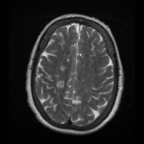 Neuroanatomy Glossary: Watershed (ACA/MCA) Stroke | ditki medical ...
