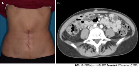 Long-term survival of the Sister Mary Joseph nodule originating from breast cancer: A case report