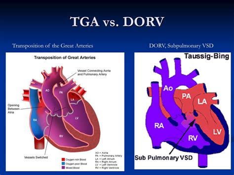 PPT - Double Outlet Right Ventricle - Spectrum, Variations, and ...