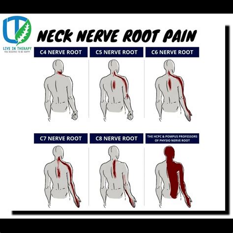 Neck Nerve Root Pain Description (C4-C8): It is a cervical radiculopathy when the nerve roots in ...
