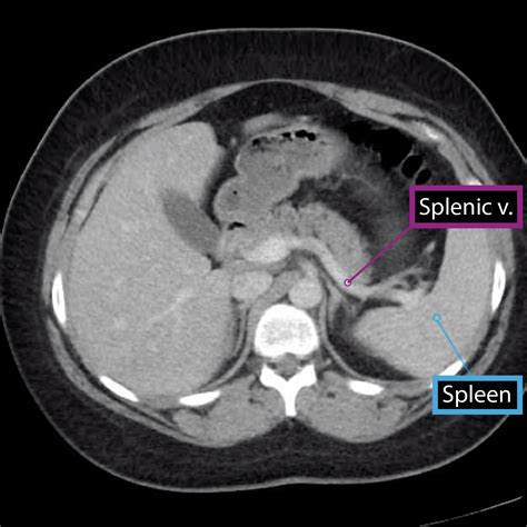 Gross Anatomy Glossary: Spleen Imaging | ditki medical & biological ...