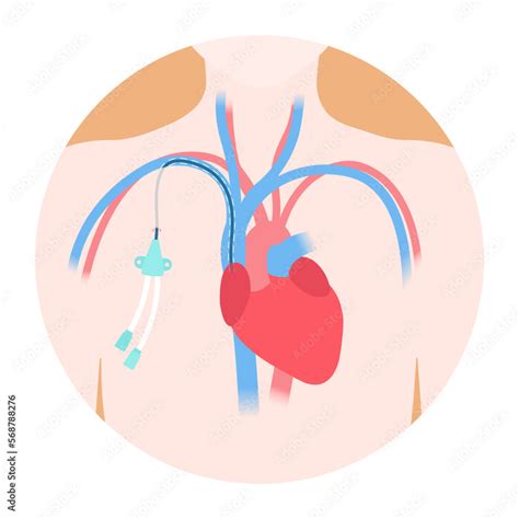 Image result for CVC Line Distal Port