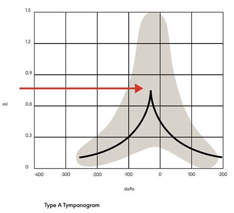 Tympanogram Types And Meanings at William Everhart blog