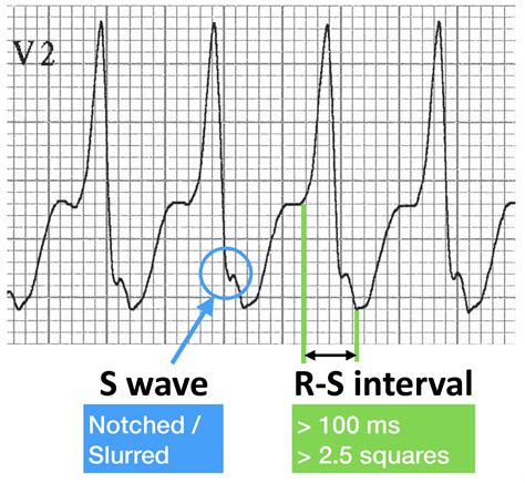 ECG Case 046 • LITFL • ECG Top 100 Self-Assessment Quiz