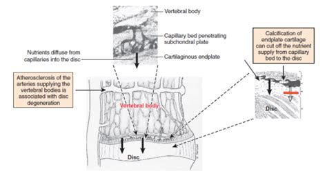 The Smoker’s Spine - MedSpine
