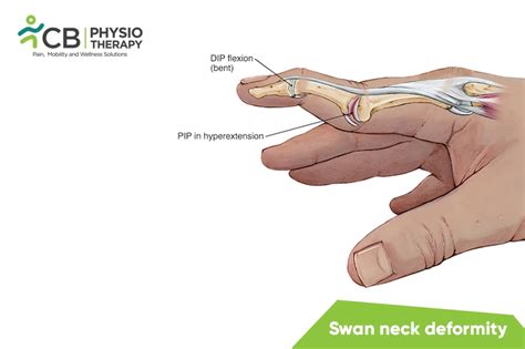 Best Treatment for Swan Neck Deformity in Gurgaon | Book Appointment ...