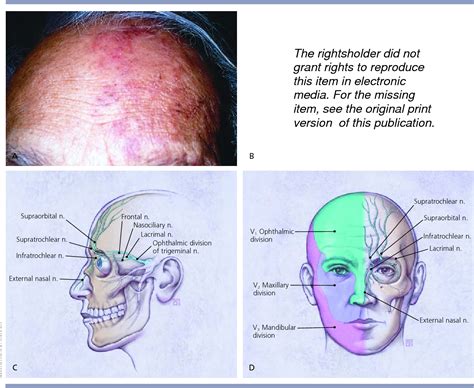 Best Home & Kitchen Appliances: Herpes Zoster Eye / Herpes zoster ophthalmicus Wiki : Herpes ...