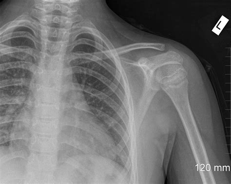 Normal X Ray Shoulder Child at Terry Haskell blog