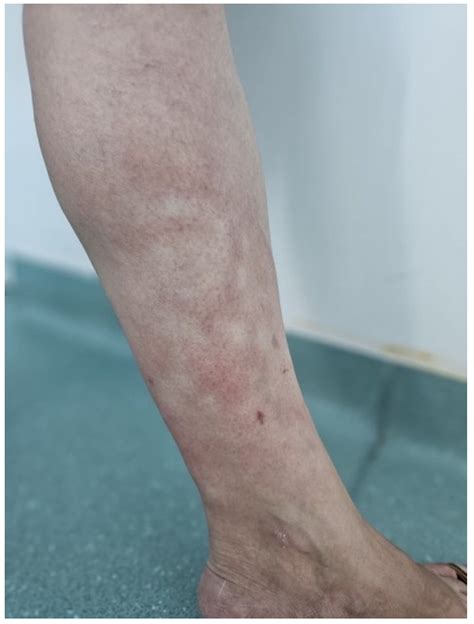 Acrodermatitis Chronica Atrophicans in a Patient with Pulmonary ...