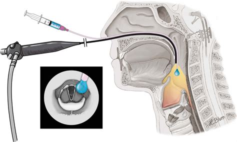 FEES‐based assessment of pharyngeal hypesthesia—Proposal and validation ...