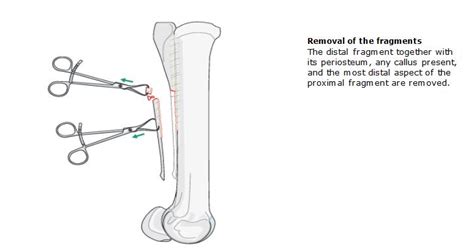 Splint Removal 的图像结果