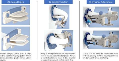 Penile Traction Therapy Before And After at Brodie Bolden blog