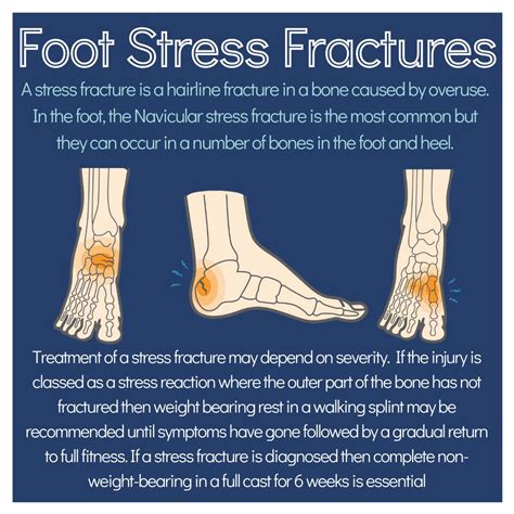 Calcaneus Stress Fracture