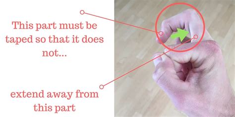 Image result for Finger Dislocation Reduction