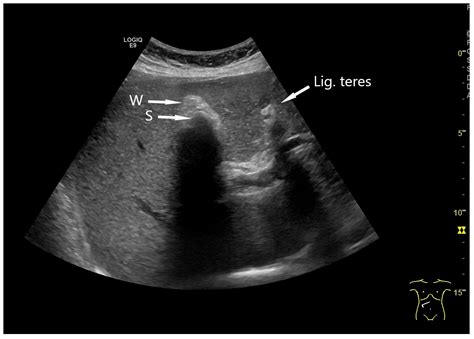 Ultrasound of the Gallbladder—An Update on Measurements, Reference ...
