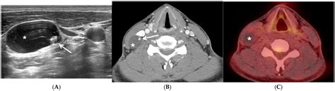 Comparative Analysis of Metastatic Thyroid Carcinoma versus Ectopic Thyroid Carcinoma in Lateral ...