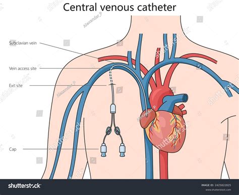 Central Venous Access