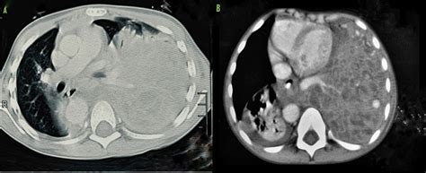 Hybrid lung lesion: an accidental finding | Pediatric Oncall Journal