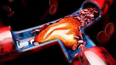 Image result for Calcium Buildup Signs