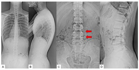New Spinal Shortening Technique for Tethered Cord Syndrome: A Technical Note