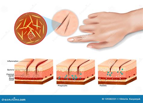 Tissue Injury and Inflammation. Stock Vector - Illustration of process, bleeding: 139382231