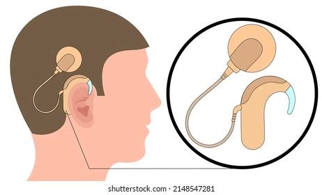 Image result for Cochlear