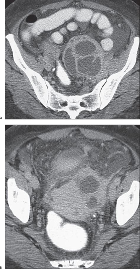 Image result for Axillary Abscess