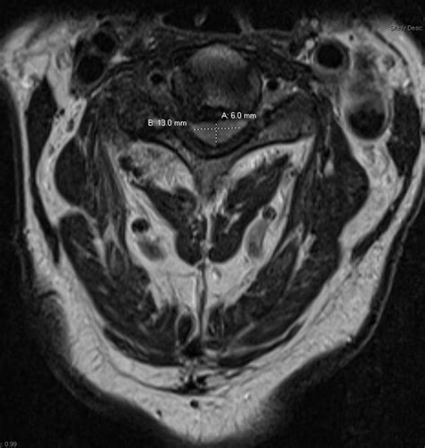 Image result for Max Cervical Compression Test