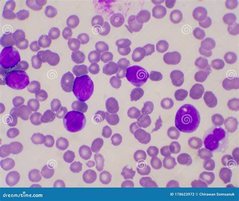 Absolute Immature Granulocytes Leukemia at Aiden Scurry blog