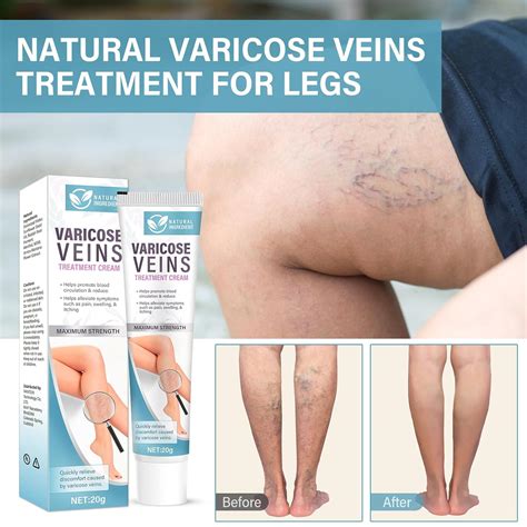 CURECURE Varicose Veins Treatment for Legs, Varicose Veins India | Ubuy